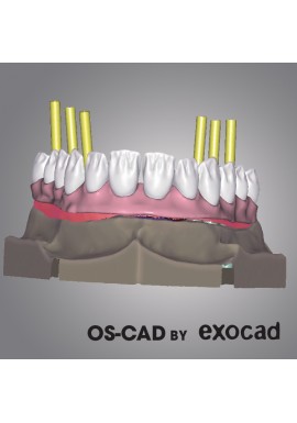 IMPLANT - OS-CAD BY EXOCAD