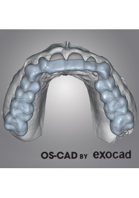 GOUTTIERE- OS-CAD BY EXOCAD