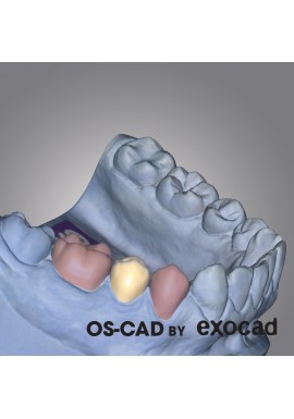 GOUTTIERE- OS-CAD BY EXOCAD