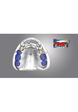 PROTHESE PARTIELLE - OS-CAD BY EXOCAD