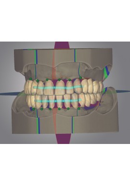 PROTHESE PARTIELLE - OS-CAD BY EXOCAD