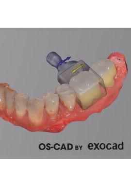 CHAIRSIDE - OS-CAD BY EXOCAD