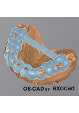 CHIRURGIE GUIDEE - OS-CAD  BY EXOCAD