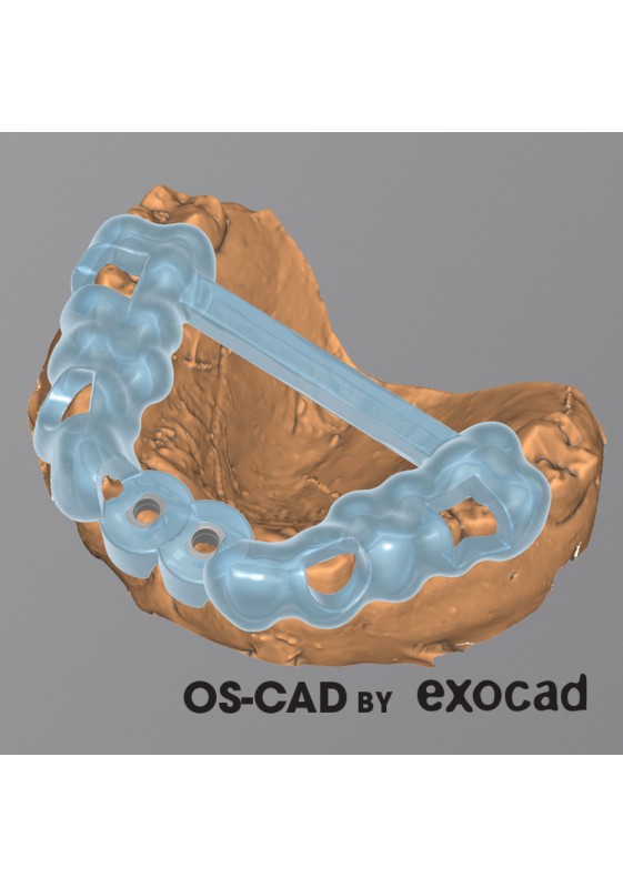 CHIRURGIE GUIDEE - OS-CAD  BY EXOCAD