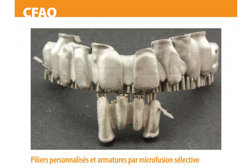 Piliers personnalisés et armatures par microfusion sélective