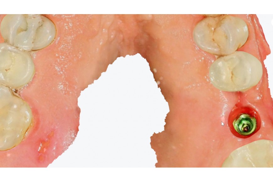 Aoralscan Elite - Cas sur implant